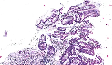 Figure 1A : Atrophie légère antrale avec métaplasie intestinale