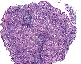 Figure 1B : Atrophie modérée antrale