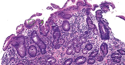 Figure 1C : Métaplasie complète (flèche) et incomplète (cercle)
