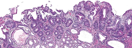 Figure 1D : Dysplasie de bas grade