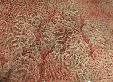 Figure 4B : Métaplasie intestinale en mode BLI