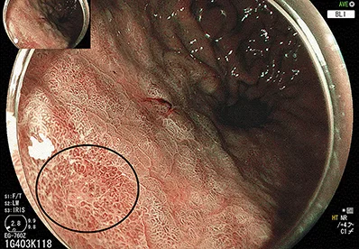 Figure 4C : Dysplasie de haut grade (dans le cercle) au sein d’une gastrite atrophique, en mode BLI