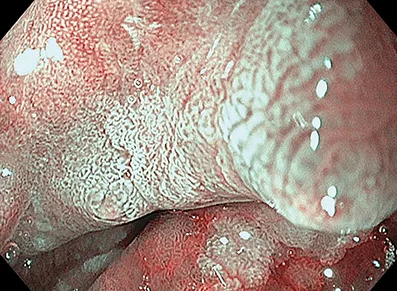 Figure 4D : Aspect de crêtes bleutées typiques de métaplasie intestinale, en mode BLI