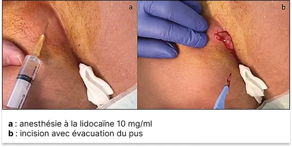 Figure 6 : Incision d’un abcès sur sinus pilonidal infecté (coll. Manuel Aubert)