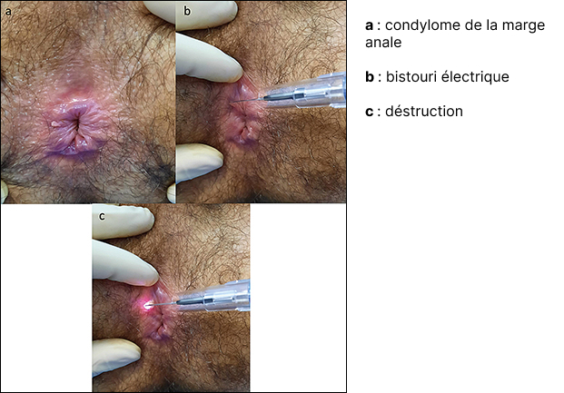 Figure 7 : Destruction de lésions condylomateuses au bistouri électrique (coll. Liza Kassouri)