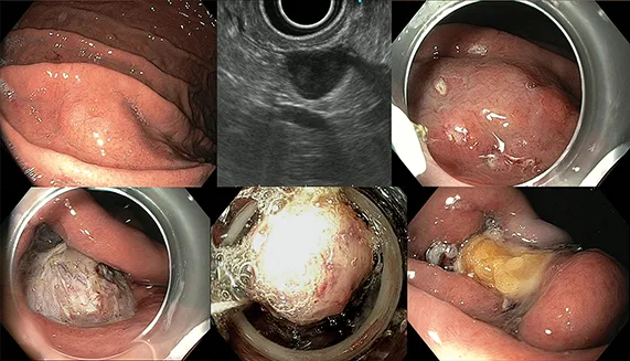 Figure 2 : Résection par FTRD d’une GIST gastrique de 15 mm
