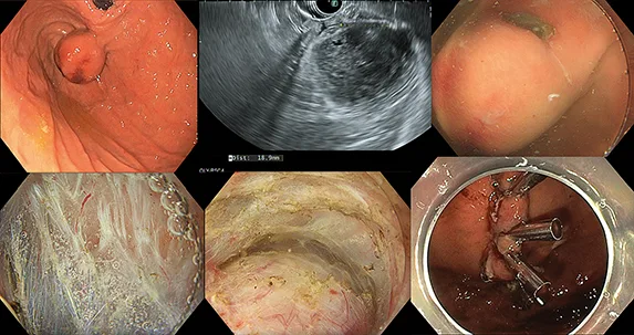 Figure 3 : Résection endoscopique d’une GIST gastrique hémorragique de 35 mm
