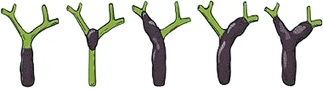 Figure 1 : Classification des cholangiocarcinomes selon Bismuth et Corlette