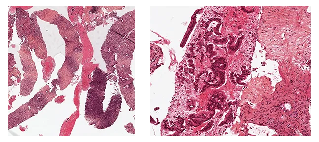 Figure 2 : Matériel obtenu par ponction à l’aiguille coupante d’un adénocarcinome pancréatique