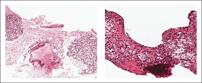 Figure 4 : Matériel obtenu après ponction à l’aiguille coupante d’une métastase pancréatique d’adénocarcinome à cellules claires du rein
