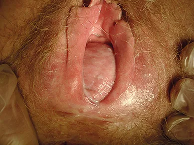 Figure 1 : Colpocèle postérieure en rapport avec une rectocèle