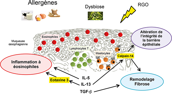 Figure 1 : Les allergènes activent les lymphocytes T qui sécrètent différentes interleukines (IL). L’IL-5 et l’éotaxine 3 (dont la production est stimulée par l’IL-13) attirent les polynucléaires éosinophiles. Les IL activent également des protéases comme la calpain-14 qui participe à l’altération de l’intégrité de la barrière épithéliale. Cette altération est favorisée par le reflux gastro-oesophagien (RGO) et la dysbiose oesophagienne qui sont des co-facteurs (avec les allergènes) de survenue de l’oesophagite à éosinophiles. Une activation des mastocytes et une synthèse d’IgE par les lymphocytes B est également observée. Enfin, la calpain-14 et le tumor growth factor (TGF) β participent au remodelage épithélial et au développement de la fibrose.