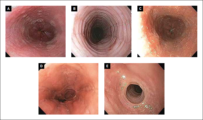 Figure 2 : Aspects endoscopiques et score EREFS (Edema, Rings, Exsudates, Furrows, Stricture). L’oedème (Edema - A) est caractérisé par une perte de la trame vasculaire. Les anneaux concentriques (Rings - B) donnent un aspect pseudo-trachéal à l’oesophage. Les exsudats (Exsudates - C) se présentent sous la forme d’un piqueté blanchâtre. Les stries longitudinales (Furrows - D) et les sténoses (Stricture - E) sont également des aspects endoscopiques rencontrés dans l’oesophagite à éosinophiles. Ces différents aspects endoscopiques sont cotés en fonction de leur intensité et de leur étendue. L’addition des sous scores pour chaque aspect endoscopique donne le score EREFS.