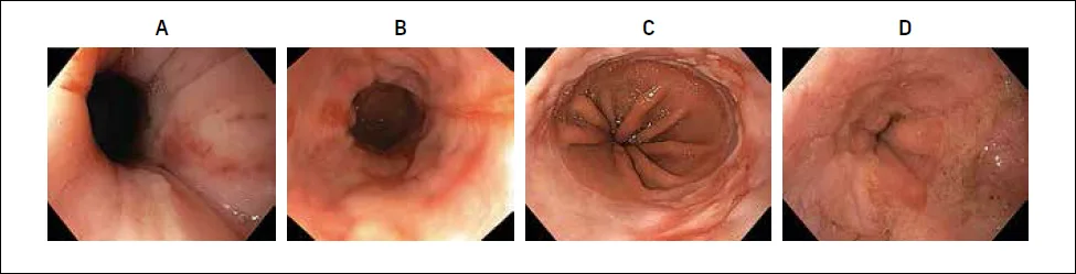 Figure 1 : Classification endoscopique de Los Angeles des oesophagites peptiques (27) A : Grade A : une ou plusieurs pertes de substance <5 mm B : Grade B : une ou plusieurs pertes de substance >5 mm limitées à la crête des plis muqueux, sans extension entre eux C : Grade C : présence d’au moins une perte de substance s’étendant entre 2 plis mais non circonférentielle (<75 % circonférence) D : Grade D : perte de substance circonférentielle