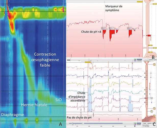 Figure 2 : Exemples d’explorations fonctionnelles oesophagiennes A : Manométrie oesophagienne haute résolution, montrant une hernie hiatale et une contraction oesophagienne péristaltique hypotonique (index de contraction distale de 190 mmHg.s.cm) B : Tracé de pH-métrie oesophagienne montrant un épisode de reflux acide (pH < 4) associé à un symptôme rapporté par le patient, considéré comme significatif car survenu dans les 2 mn suivant le reflux acide C : Tracé de pH-impédancemétrie montrant un épisode de reflux non acide (pH > 4), caractérisé par une chute d’impédance de plus de 50 %