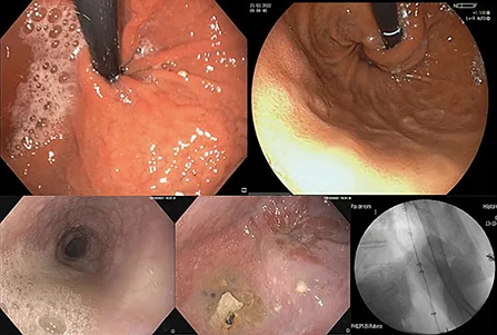 Figure 3 : Aspect endoscopique après fundoplicature