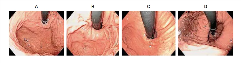 Figure 4 : Classification endoscopique de Hill des hernies hiatales, d’après (28) (en rétro-vision)