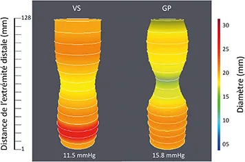 Figure 1 : Mesure de distensibilité pylorique à l’aide de la technique endoflip ® chez un volontaire sain (VS) et un malade avec gastroparésie diabétique (GP)