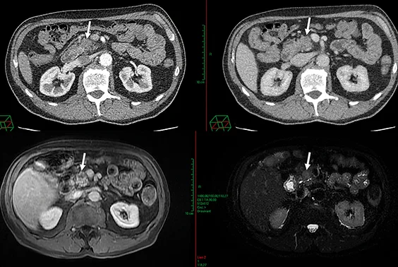 Figure 1 : AP résécable. Absence de contact veineux. Tumeur peu hypodense en scanner ayant nécessité un complément de documentation pancréatique par IRM