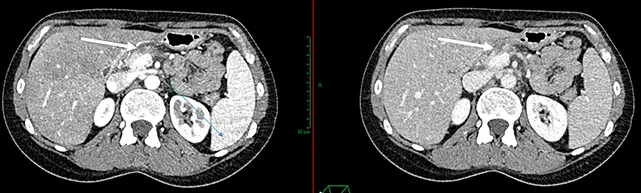 Figure 2 : AP isthmique, résécable d’emblée selon la définition du NCCN, présentant un contact veineux < 180°