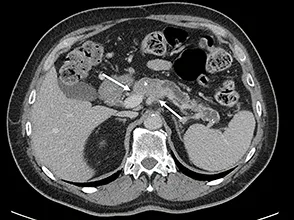 Figure 3 : AP borderline artériel. Envahissement veineux (VMS) < 180° et artériel (AMS) < 180°