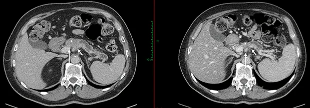 Figure 5 : AP borderline avant et après 6 cycles de chimiothérapie par mFOLFIRINOX. Réponse RECIST, avec persistance des contacts vasculaires