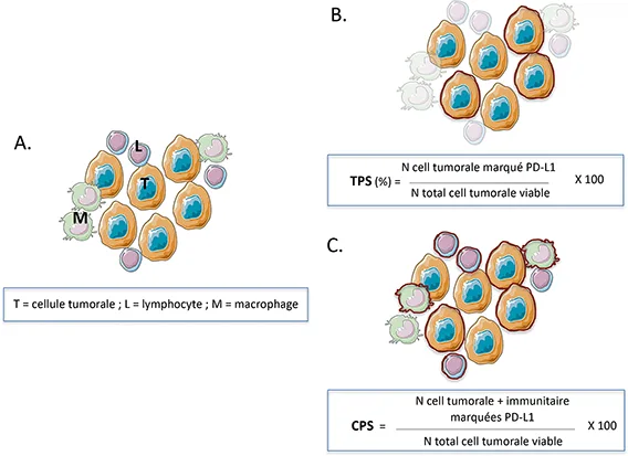 Immunothérapie dans les cancers œsogastriques - Figure 1