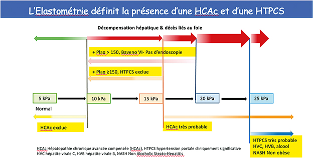 Elasticité mesurée par élastographie impulsionnelle (FibroScan®) et diagnostic d’une hépatopathie chronique avancée compensée et d’une hypertension portale cliniquement significative