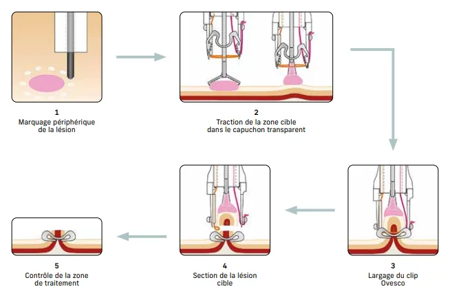 Figure 1 : Étapes de la procédure technique de la résection de plein épaisseur par système FTRD Ovesco