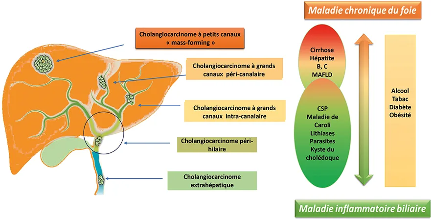 Figure 1 : les différents sous-types de cholangiocarcinomes et les facteurs de risque en fonction du sous-type