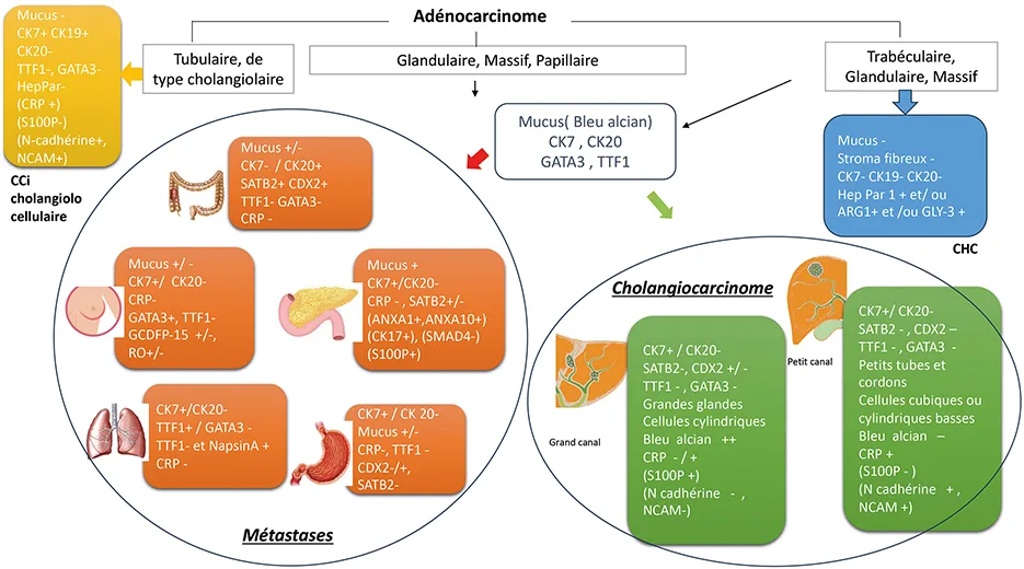 Figure 2 : Principaux diagnostics différentiels d’un adénocarcinome sur biopsie hépatique, avec profils classiques
