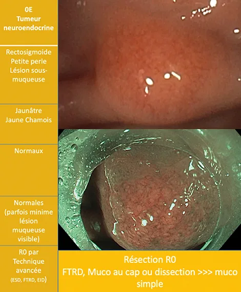 tumeurs neuroendocrines rectales