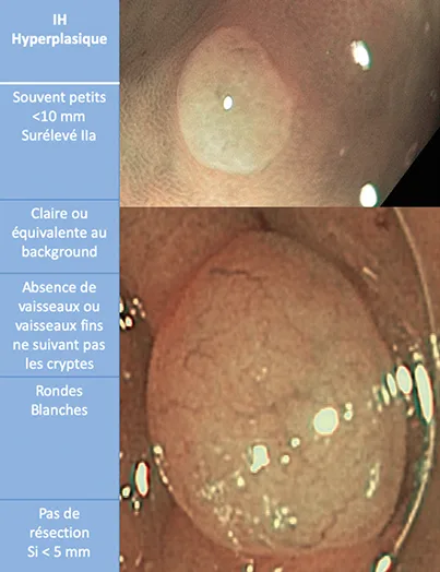 polypes hyperplasiques simples