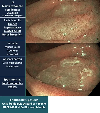 lésions festonnées sessiles