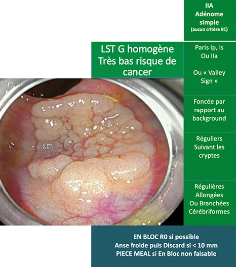 adénomes simples à bas risque de lésion dégénérée