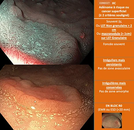 adénomes à haut risque et carcinomes superficiels (