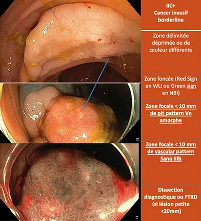 CONECCT IIC et CONNECT III