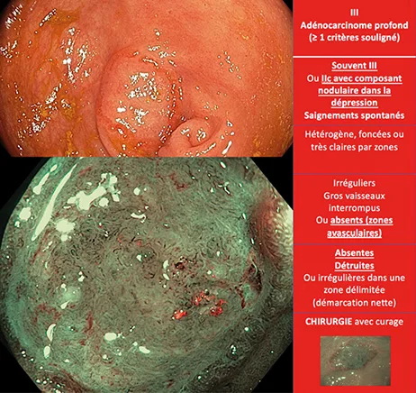 adénocarcinomes profondément invasifs