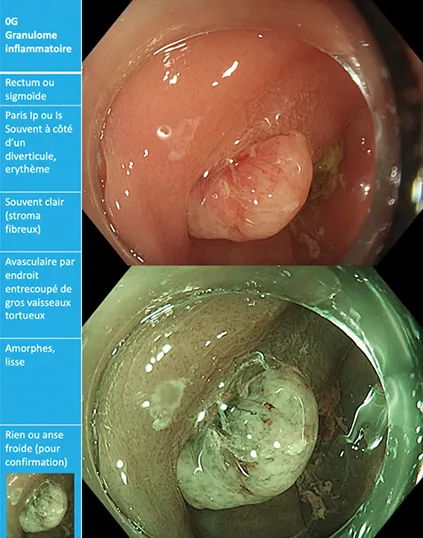 granulomes inflammatoires paradiverticulaires