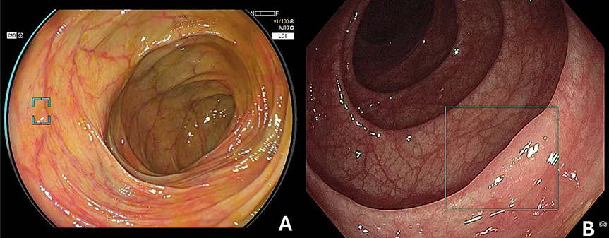 A, Image avec CAD EYE ; B, image avec ENDO-AID.