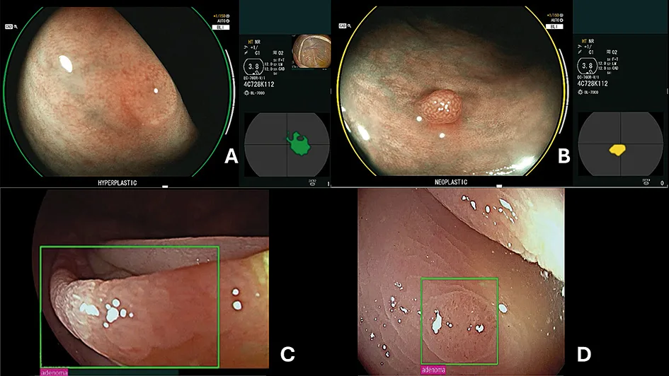 Figure 2 : Caractérisation de diminutive polypes par CADx