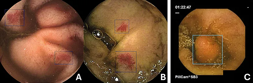 Figure 3 : Détection par IA en vidéo-capsule grêlique