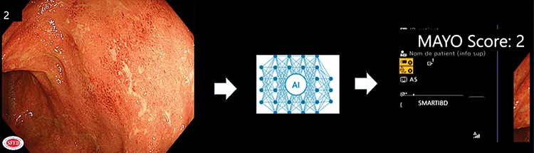 Figure 4 : Exemple de score Mayo automatisée per endoscopie avec le système « Smart IBD Olysense, Olympus »