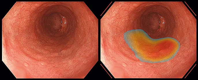 Figure 5 : Exemple de détection automatisée de zone suspect sur endobrachyœsophage
