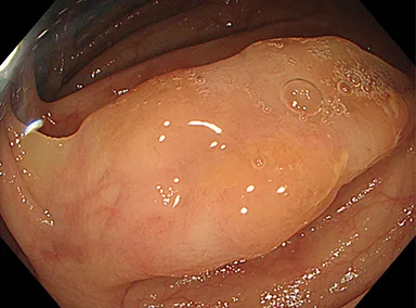 Figure 2: Exemple de lésions festonnées