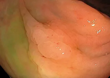 Figure 3 : Aspects d’une lésion atypique retrouvée dans la cadre d’une coloscopie de surveillance chez un patient avec maladie de Crohn, en lumière blanche, chromoendoscopie virtuelle et coloration superficielle à l’indigocarmin