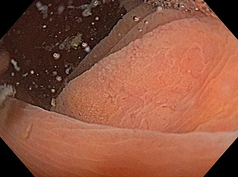 Figure 5 : Résection à l’anse froide d’un polype festonné, avec suintement hémorragique superficiel et hémostase immédiate et spontanée