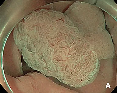 Figure 7 : Les étapes de la mucosectomie underwater : A. immersion permettant une bonne flottaison et une caractérisation par l’effet zoom de l’eau et grâce à la chromoendoscopie virtuelle ; B. ouverture de l’anse chaude qui est plaque contre la
paroi colique ; C. fermeture progressive de l’anse par l’IDE pendant que l’endoscopiste pousse l’anse vers l’avant ; D. analyse du socle de résection et coagulation des vaisseaux visibles à la pointe de l’anse
