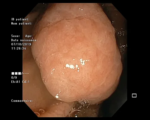 Photo 1 : hétérotopie gastrique duodénale