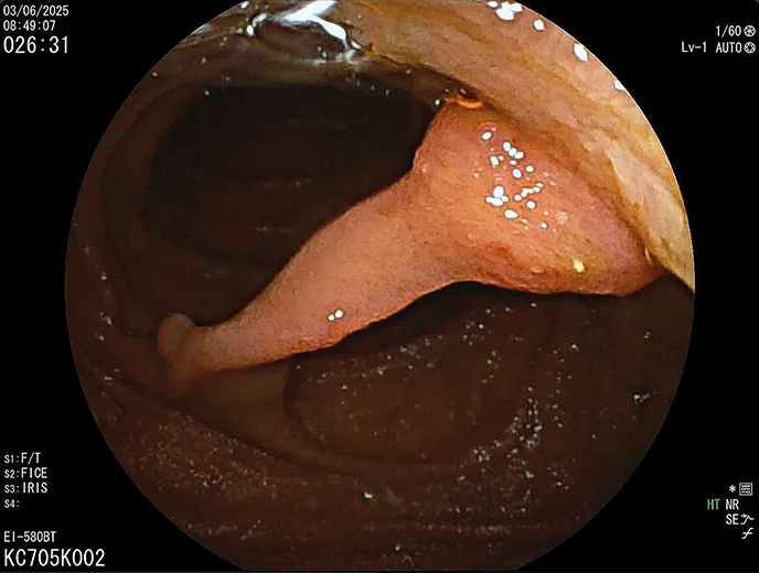 Figure 4 : polype hamartomateux (Dr JC Valats)